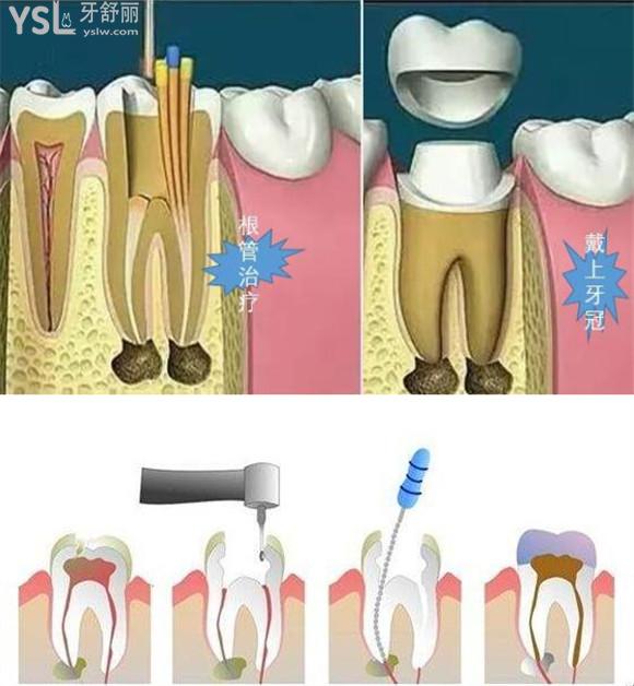 根管治疗