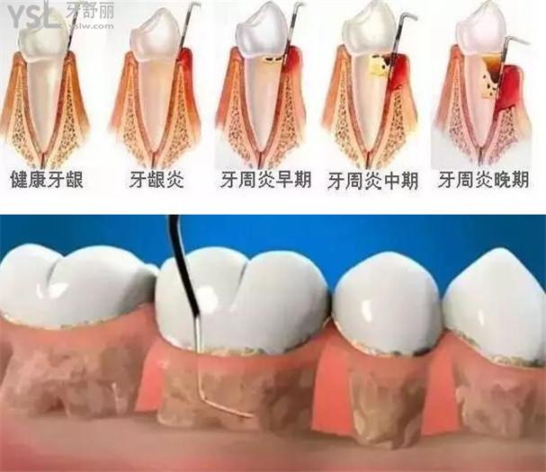 刮牙周是做什么的