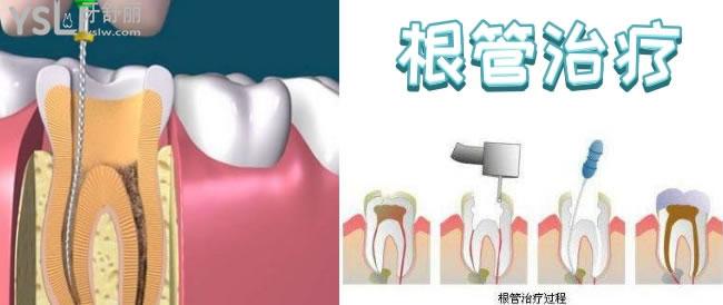 牙髓炎怎么治疗才能根除