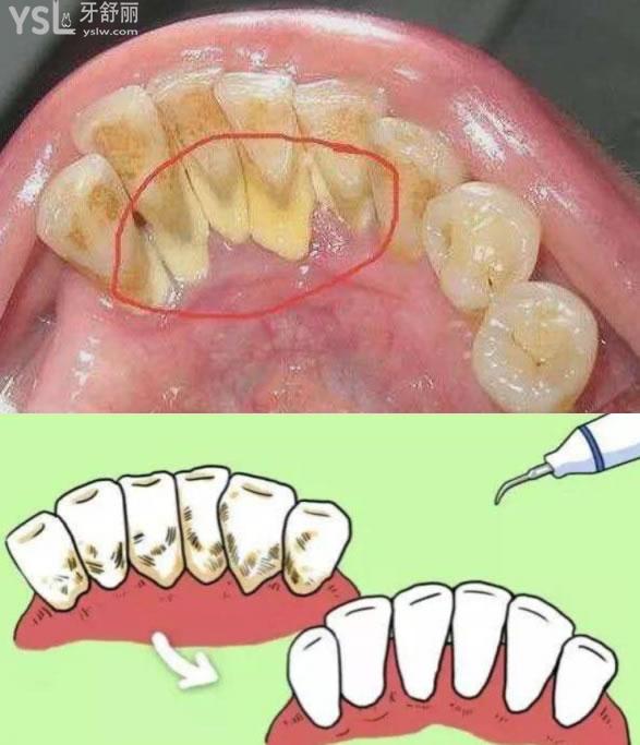 牙结石
