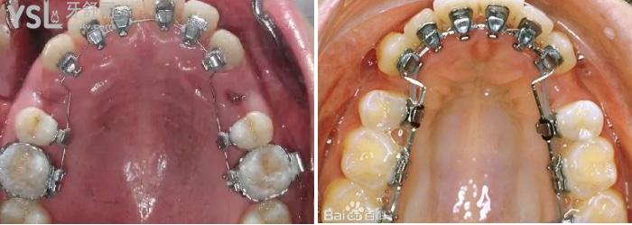 舌侧矫正.jpg