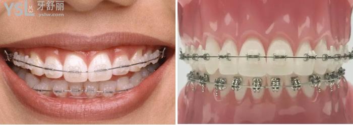 陶瓷半隐形矫正.jpg