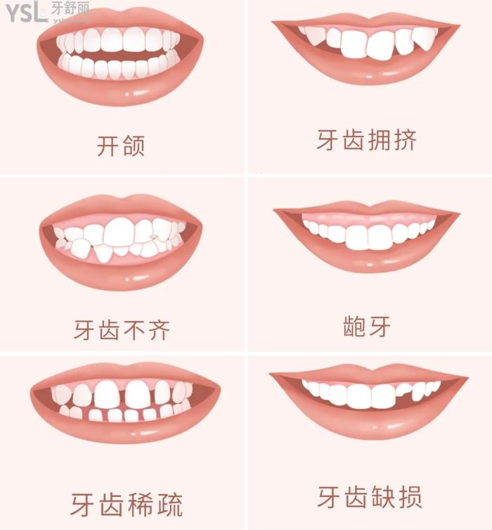 正畸适用牙列症状.jpg
