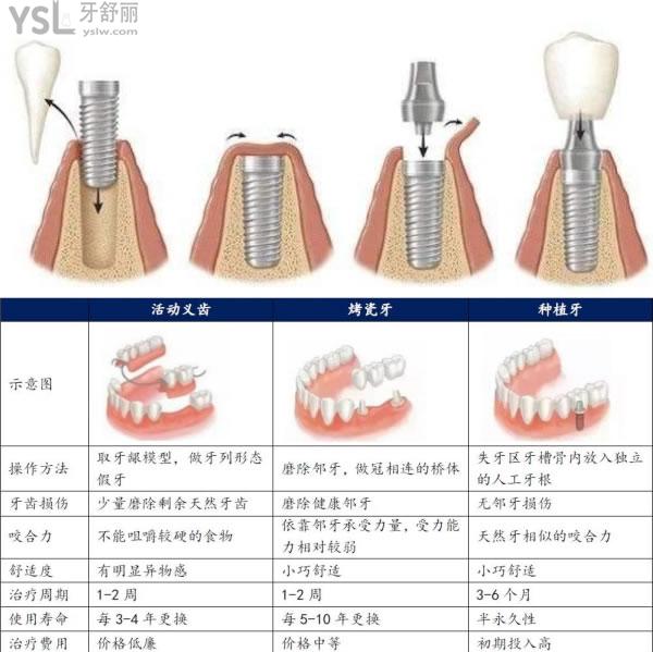 种植牙介绍.jpg