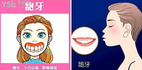 改善龅牙小妙招动作get！轻度龅牙患者速看龅牙怎么改善