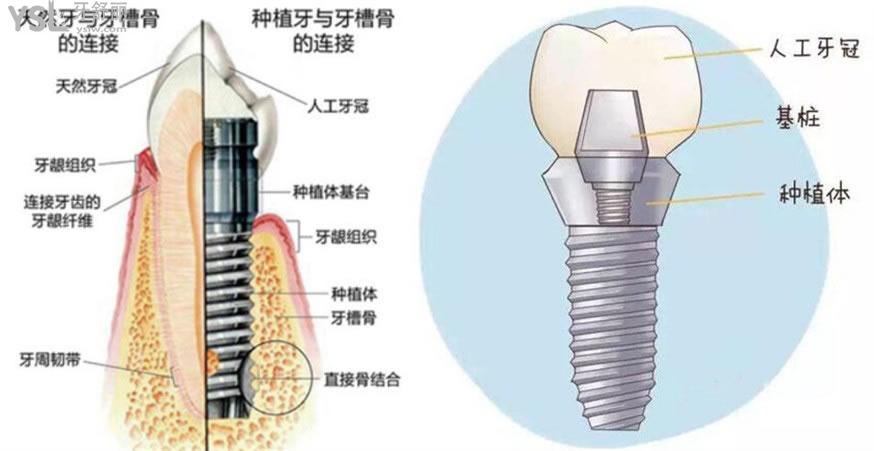 种植牙公办私立价格