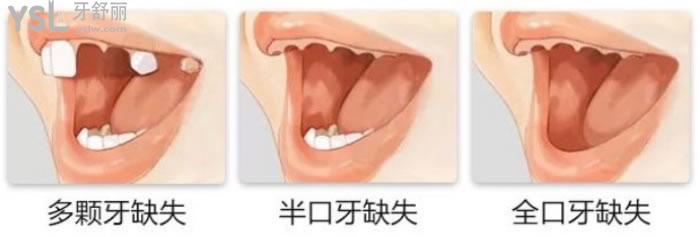 上海哪家医院种植牙好