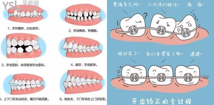牙齿矫正的难度分级标准是什么？重度牙齿畸形可以用隐形牙套吗？