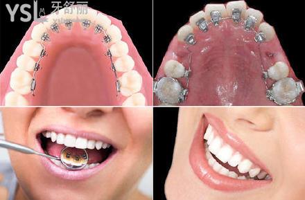 牙齿矫正的难度分级标准是什么？重度牙齿畸形可以用隐形牙套吗？