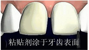 超模瓷贴面和全瓷贴面的区别是什么，牙贴面多少钱，牙贴面有什么后遗症吗