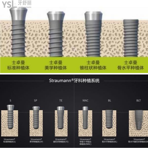 瑞士士卓曼iti种植牙多少钱一颗和其他种植体相比优势是什么