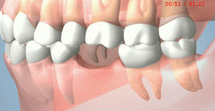 微创种植牙和普通种植牙区别是什么？要不要缝线？微创种植牙的利弊？