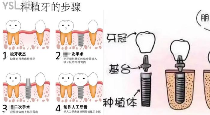 包头义隆口腔种一颗牙多少钱