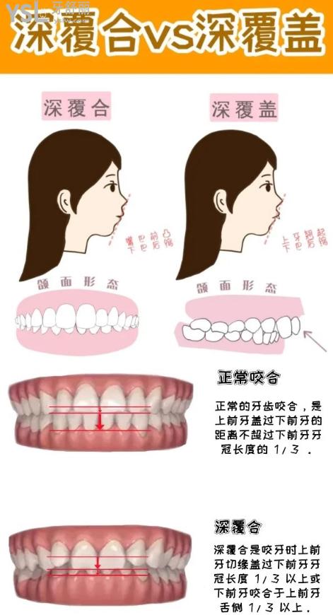 深覆合和深覆盖的区别