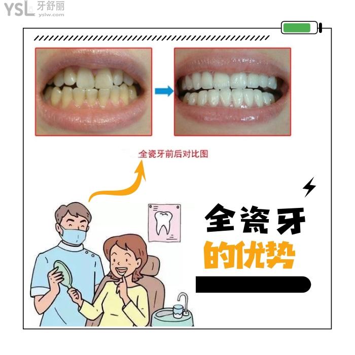 格莱美全瓷牙是进口的还是国产的