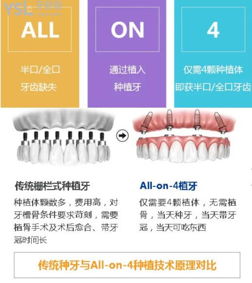all-on-4种植牙优势