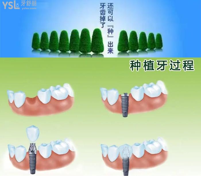 广州种植牙哪个医院做的好?这些有名的种植牙医生价格公道口碑好不可错过!
