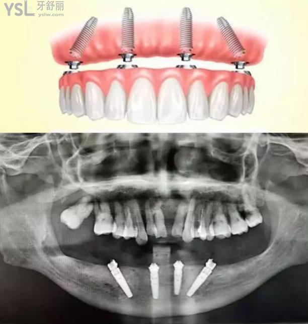 半口种植牙图