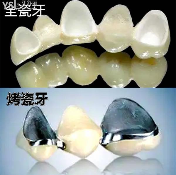 西安全瓷牙套一颗多少钱盘点西安全瓷牙哪家便宜换换牙冠哪家好