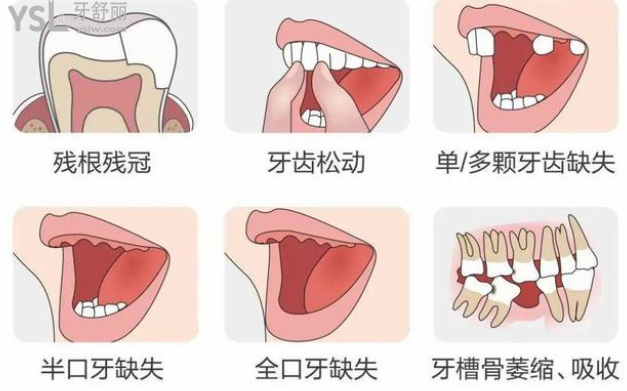 今年比较火的种植牙补贴，郑州植得口腔医院响应号召了！吹爆了！