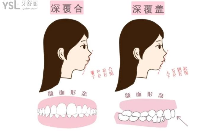 深覆合和深覆盖图例