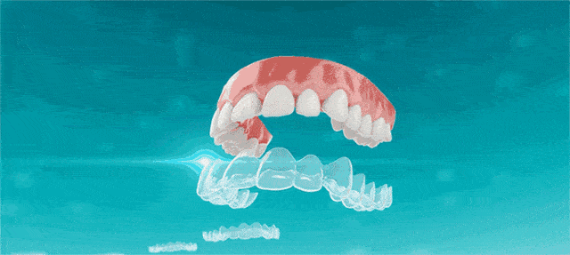 厦门隐适美矫正大概多少钱