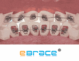 厦门隐适美矫正大概多少钱