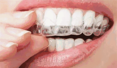 厦门隐适美矫正大概多少钱