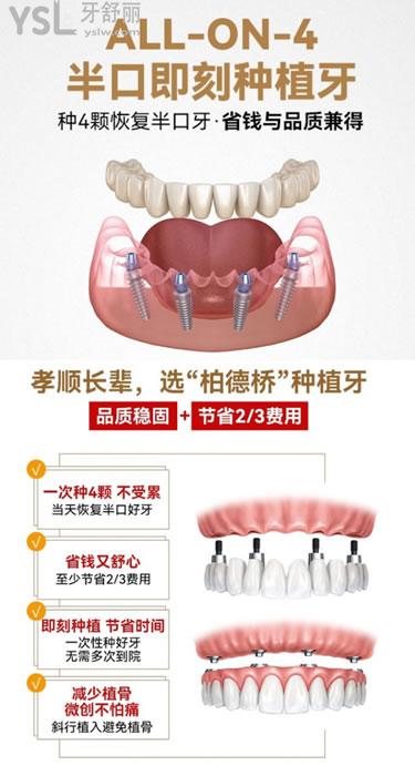 柏德口腔all-on-4半口即刻种植牙优势