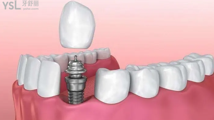 北京斯迈尔齿科医院超值大放送啦！奥齿泰、登腾、皓圣、B&B种植体大优惠，让你找到适合自己的种植牙体