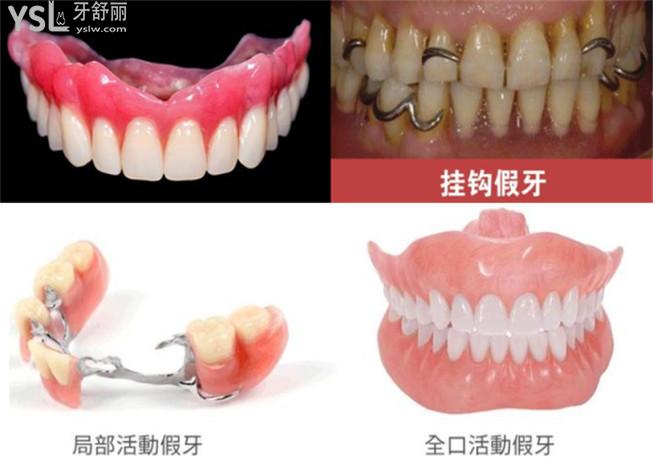 上海装活动假牙多少钱 包含单颗/全口吸附性义齿价目表