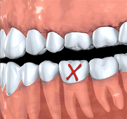 牙齿缺失的影响