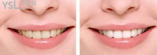 我又挖到宝啦！深圳世纪河山口腔医院隐适美低至26999！