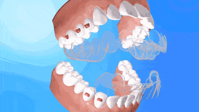 牙齿矫正透明牙套