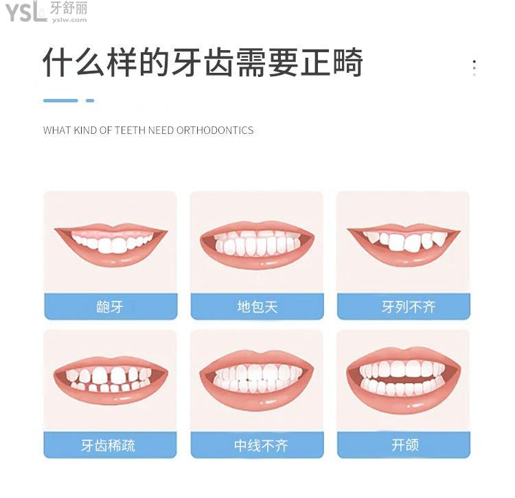 真香！上海鼎植口腔医院隐适美你猜多少钱？