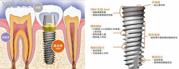 贵州医科大学附属医院牙科种植体是什么品牌