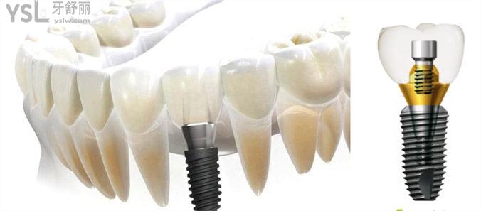 重庆种植牙多少钱一颗2022价格表 正规又便宜的牙科推荐