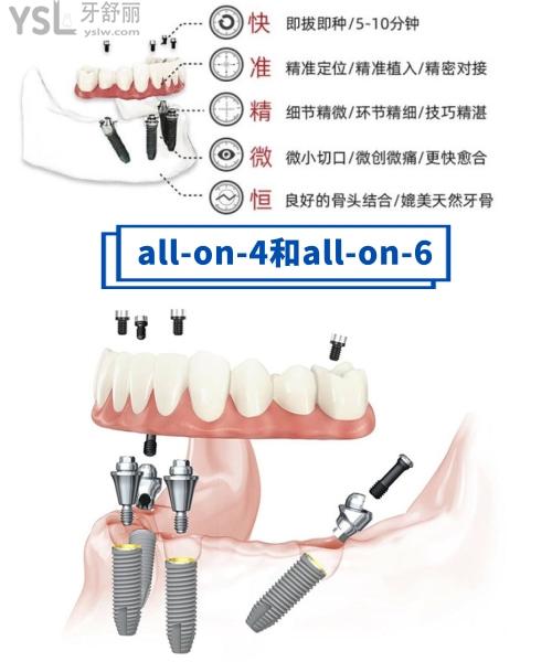 allon4和allon6半全口种植牙区别