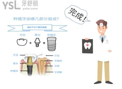价格区别**的种植牙欧洲的和韩国的对比  应该怎么选
