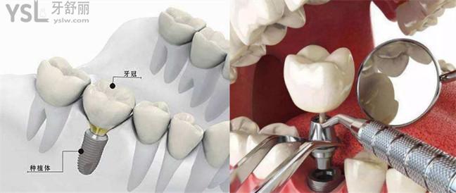 再生牙是真的吗还是假的 种植牙手术真的靠谱吗？