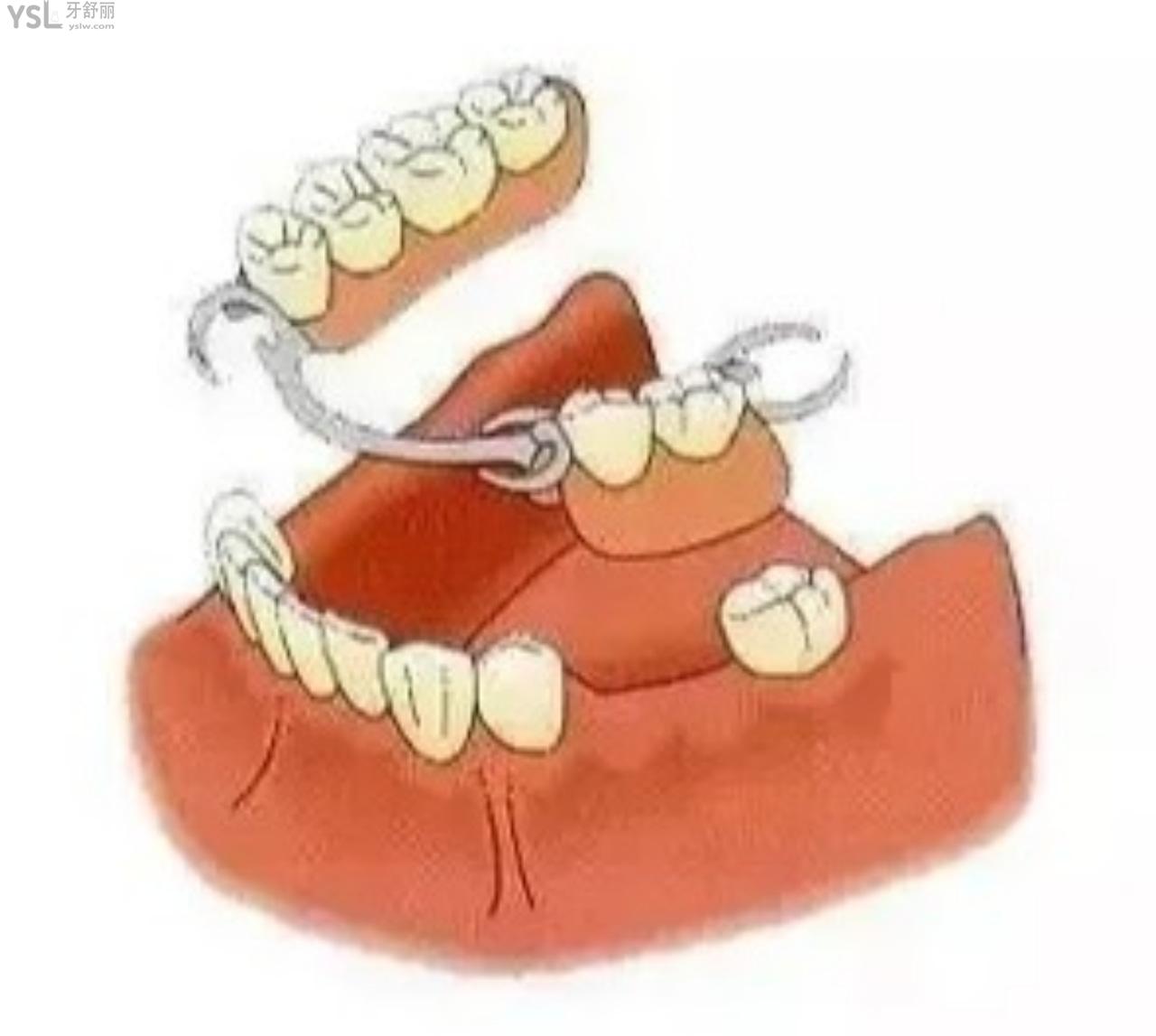 固定假牙换成没有挂钩的活动假牙好吗