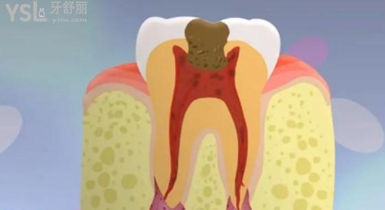 牙髓炎图