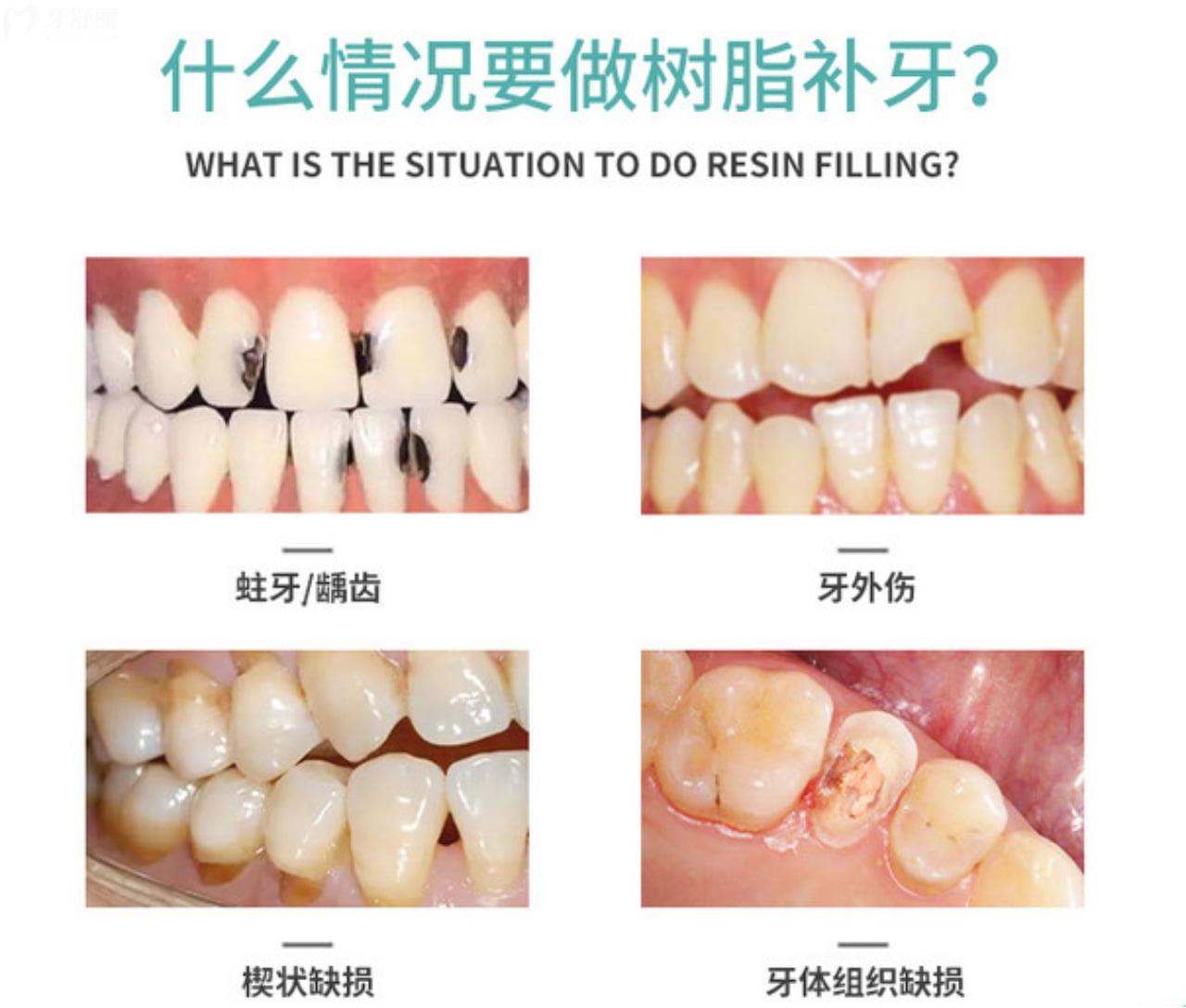 什么情况要做树脂补牙