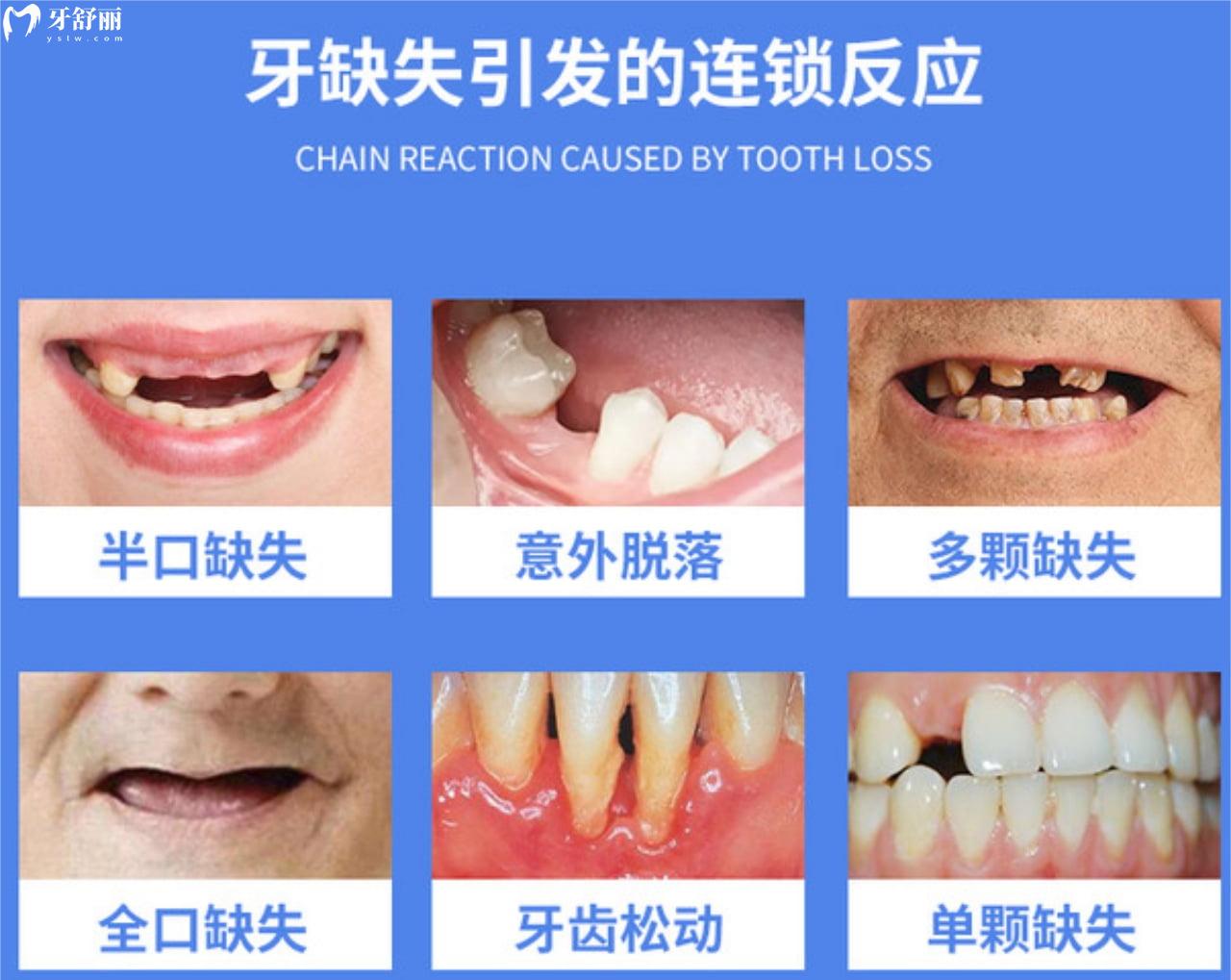 牙齿缺失不管的危害