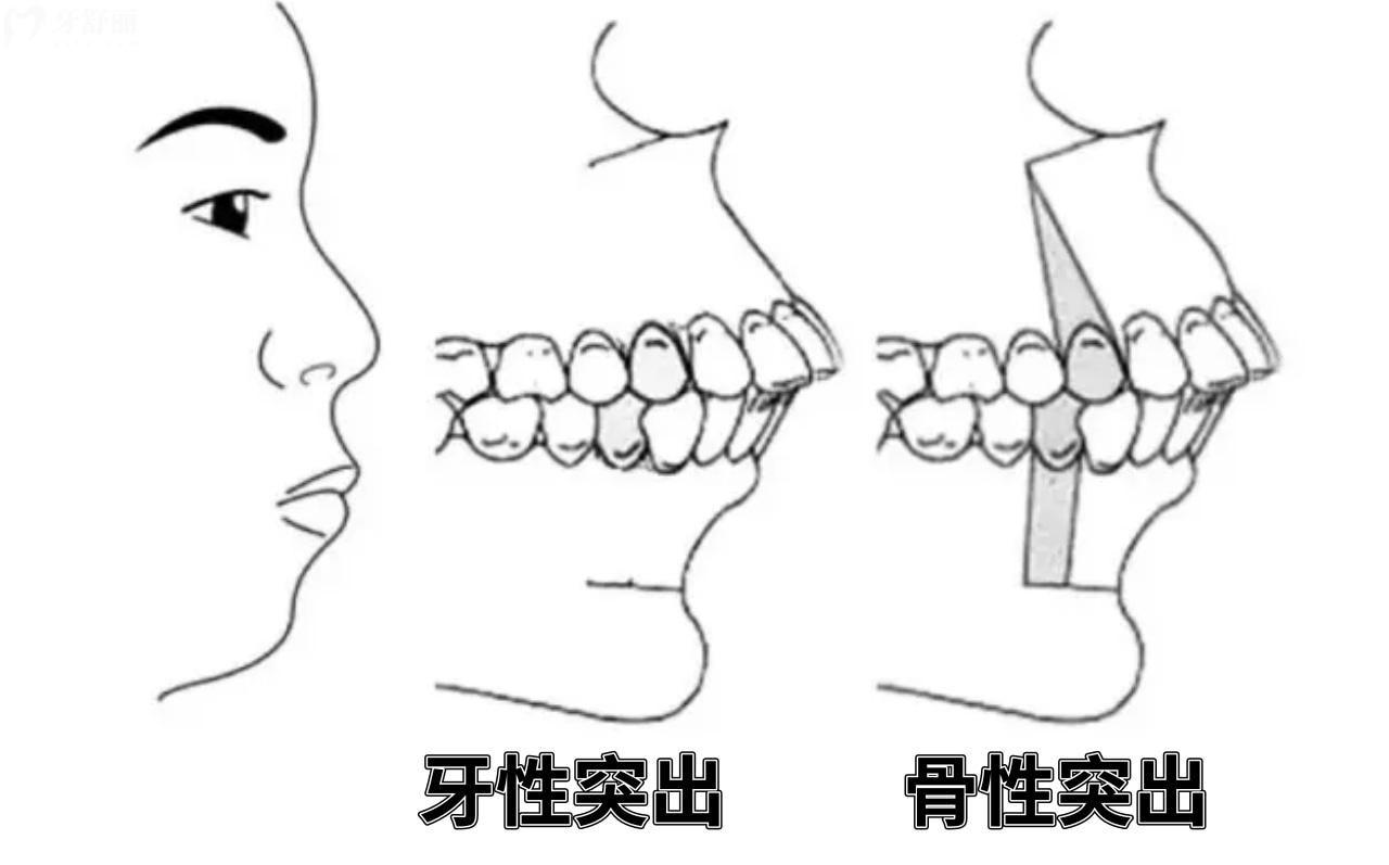 骨性矫正和牙性矫正如何分辨
