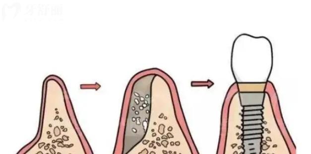 种植牙过程图
