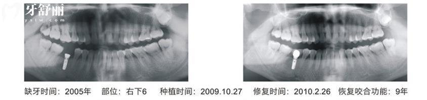 浙江广慈种植牙有没有假货