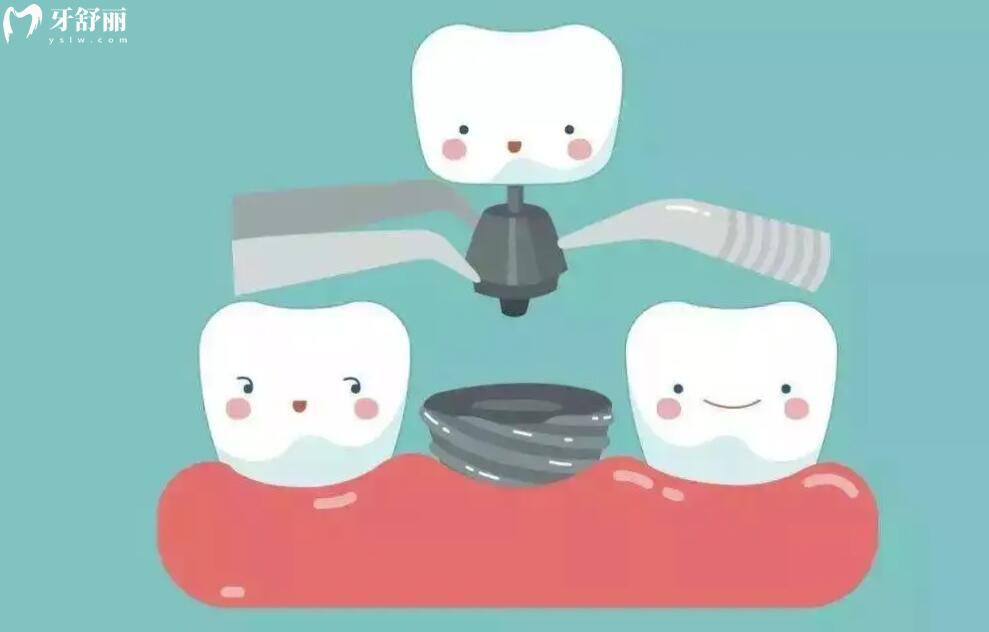 种牙之前需要注意什么