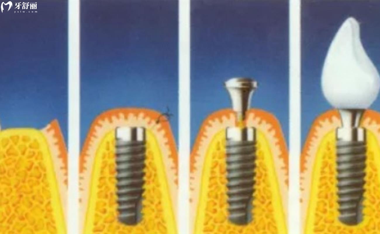 德国贝格种植牙是什么材质