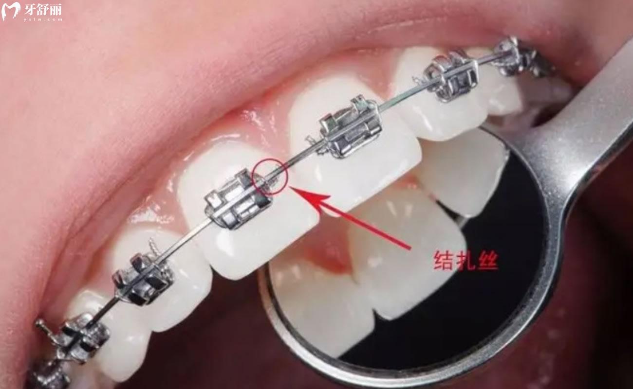 美国ao奥美金属自锁托槽